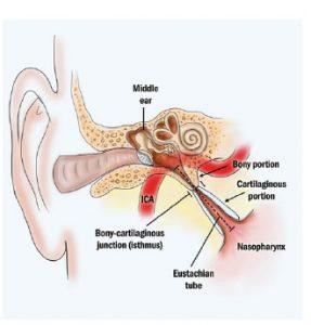 Obstructed Eustachian Tube