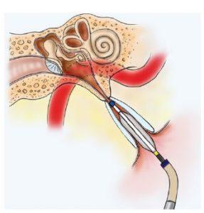 Eustachian Tube Balloon Dilation