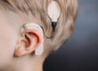 Cochlear Implants