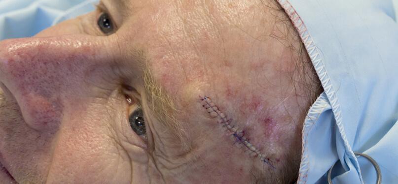 Skin Cancer (Mohs) Reconstruction