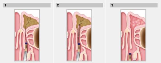 Minimal Invasive Office Procedures