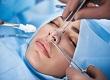 Rhinoplasty (Nose Surgery)