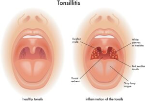 medical-illustration-of-the-symptoms-of-tonsillitis